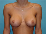 Dr. Serra Plastic Surgery Before & After