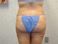 Dr. Serra Plastic Surgery Before & After